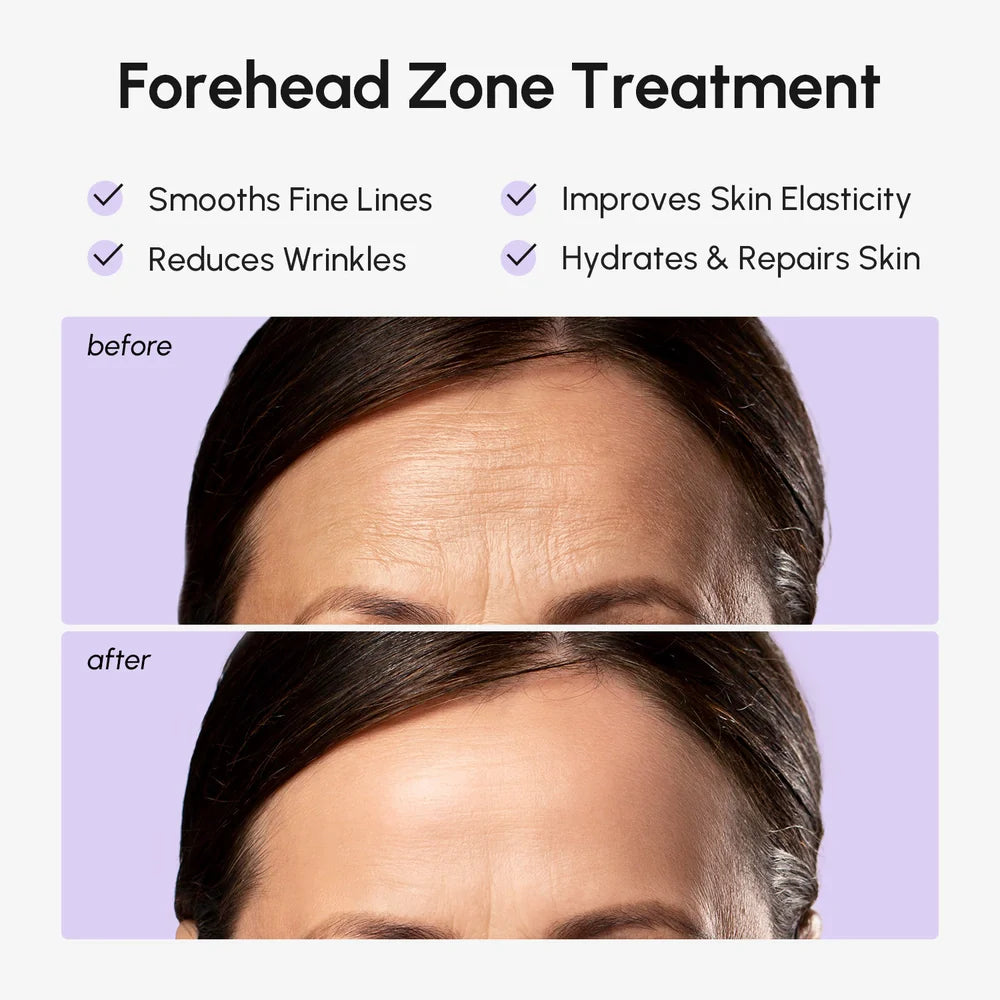 Marée anti-wrinkle forehead hydrogel patches applied to a woman's forehead, shown against a clean light background